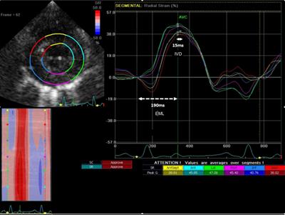 Left ventricular dyssynchrony as marker of early dysfunction in premature ventricular contraction-induced cardiomyopathy